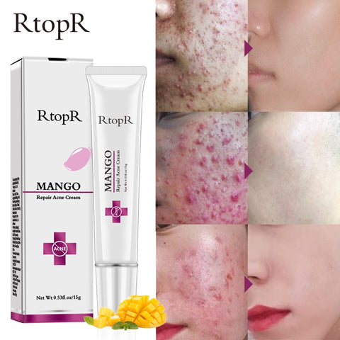 Mango Repair Acne Cream Anti Acne Spots  Acne